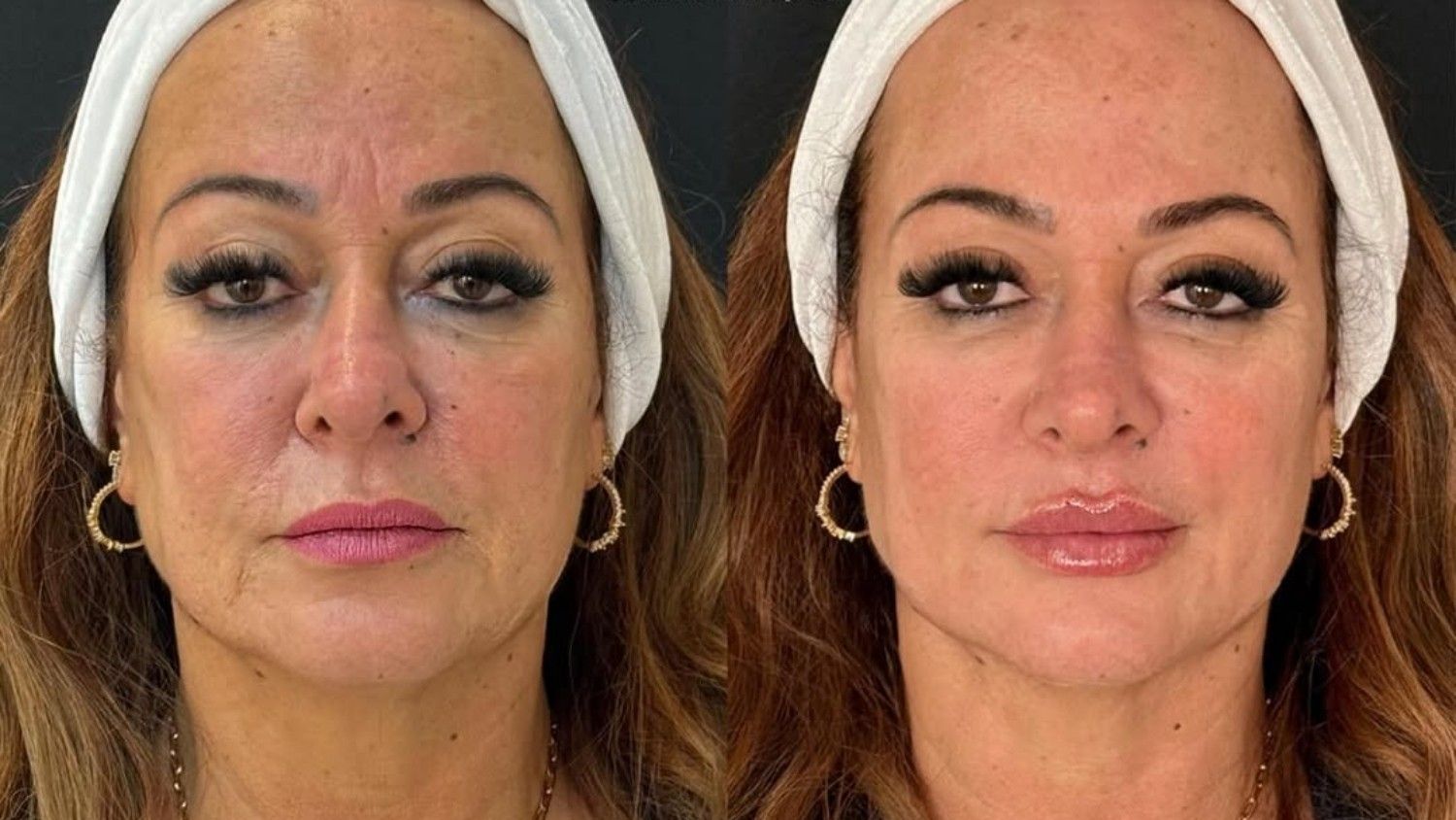 Nadine Gonçalves passa por rejuvenescimento facial com preenchimentos e toxina botulínica. Reprodução: Globo