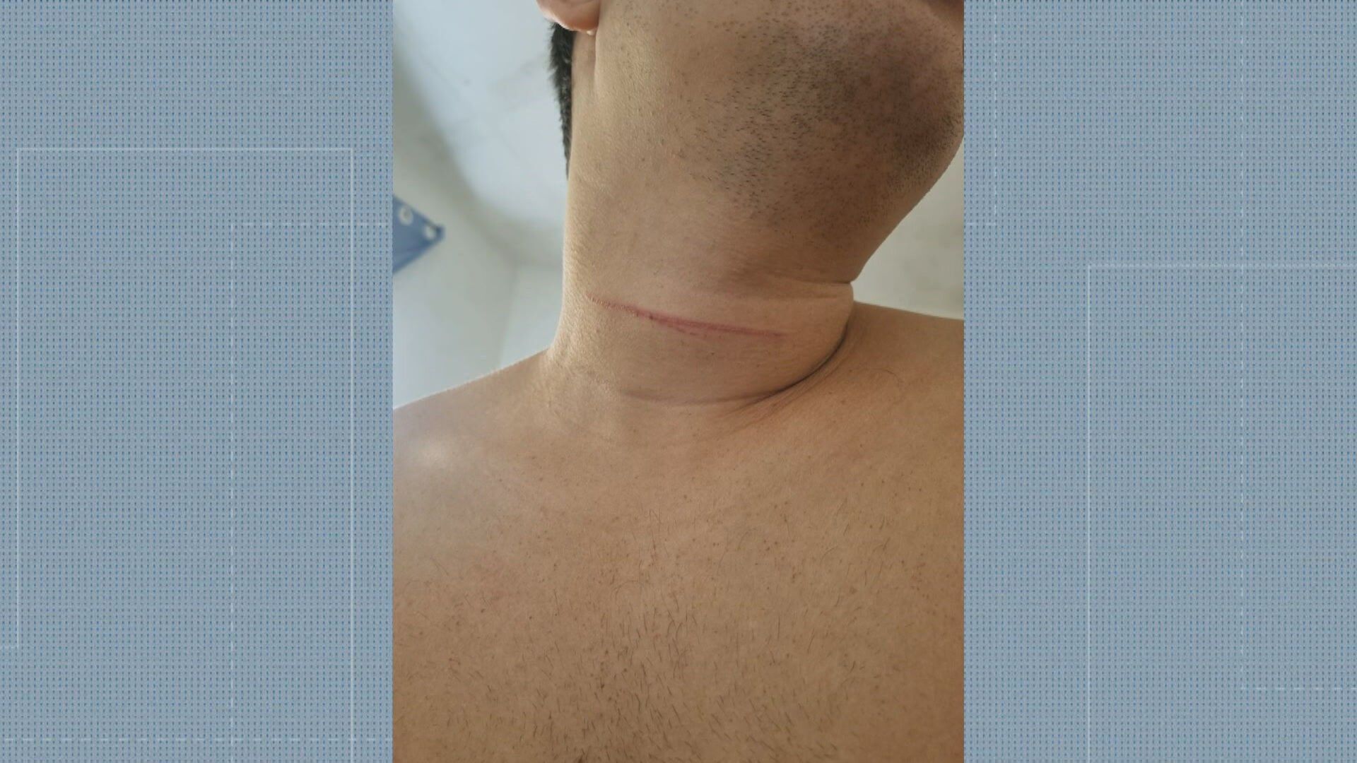 Motoboy alerta sobre o perigo de linhas chilenas após acidente na Linha Amarela. Reprodução: Globo