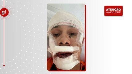 Thiago Medeiros, agredido em bar, leva 45 pontos no rosto ao defender mulheres de assédio. Reprodução: Globo