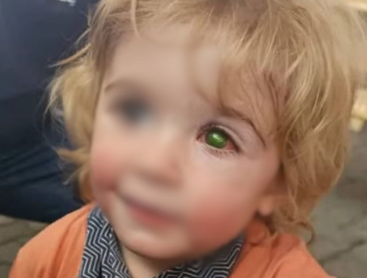 Menino Perde Visão Após Beijo com Herpes Labial