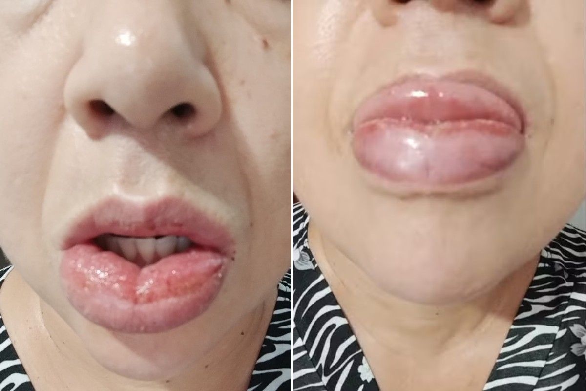 Educadora Enfrenta Reação Grave Após Usar Creme Dental Suspenso