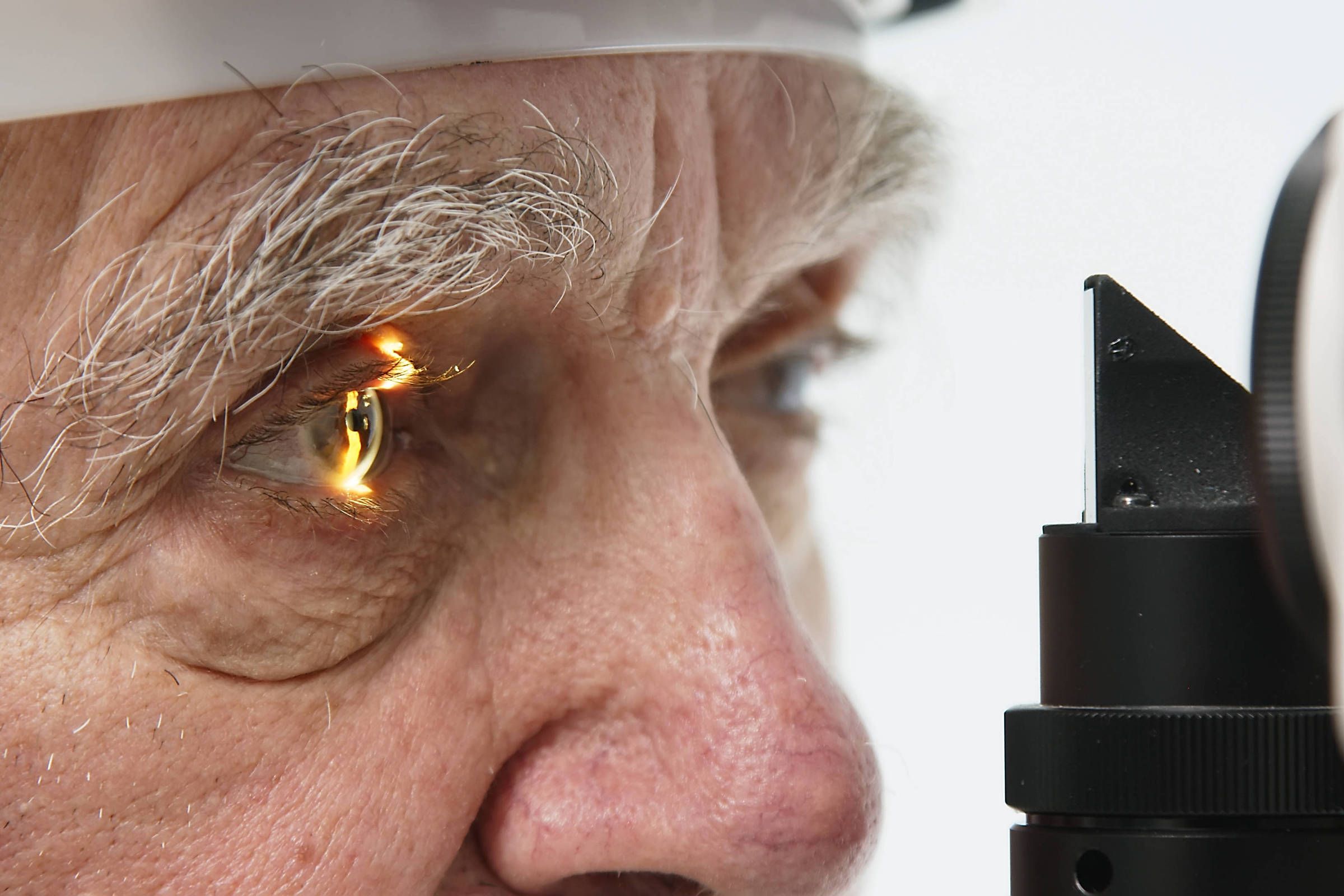 Glaucoma segue como principal causa de cegueira irreversível no país