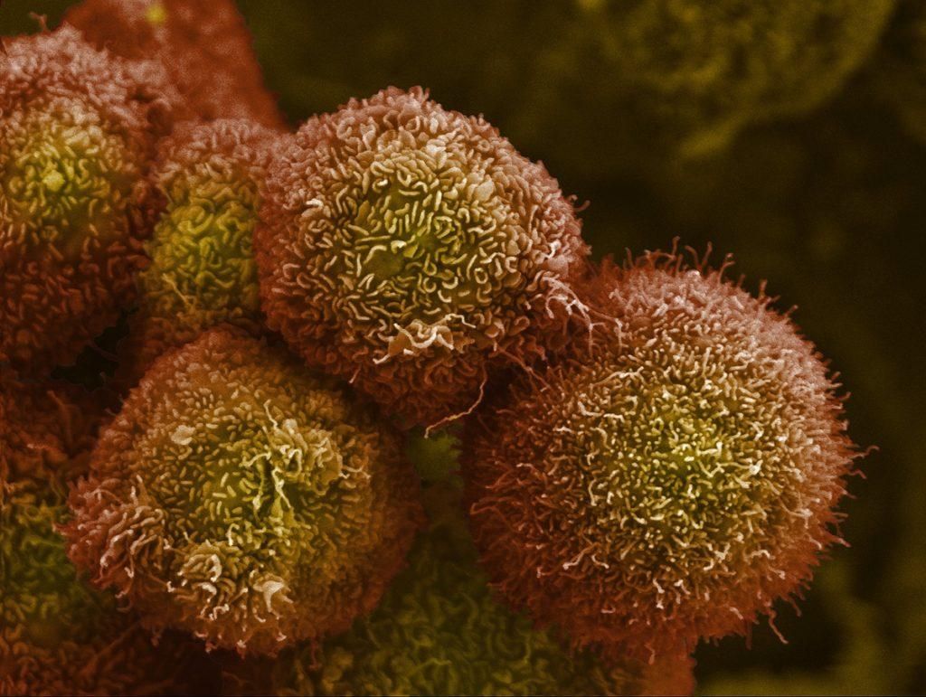 Células de câncer de pâncreas observadas em laboratório, refletindo os avanços na pesquisa oncológica. Reprodução: El País