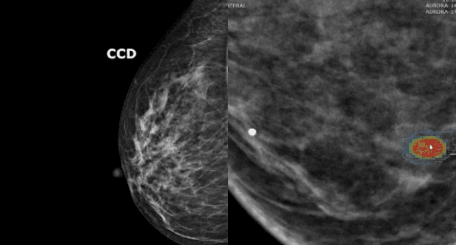 IA ajuda na triagem de mamografias em SC, acelerando diagnóstico precoce. Legenda da imagem. Reprodução: Retorno do item 11