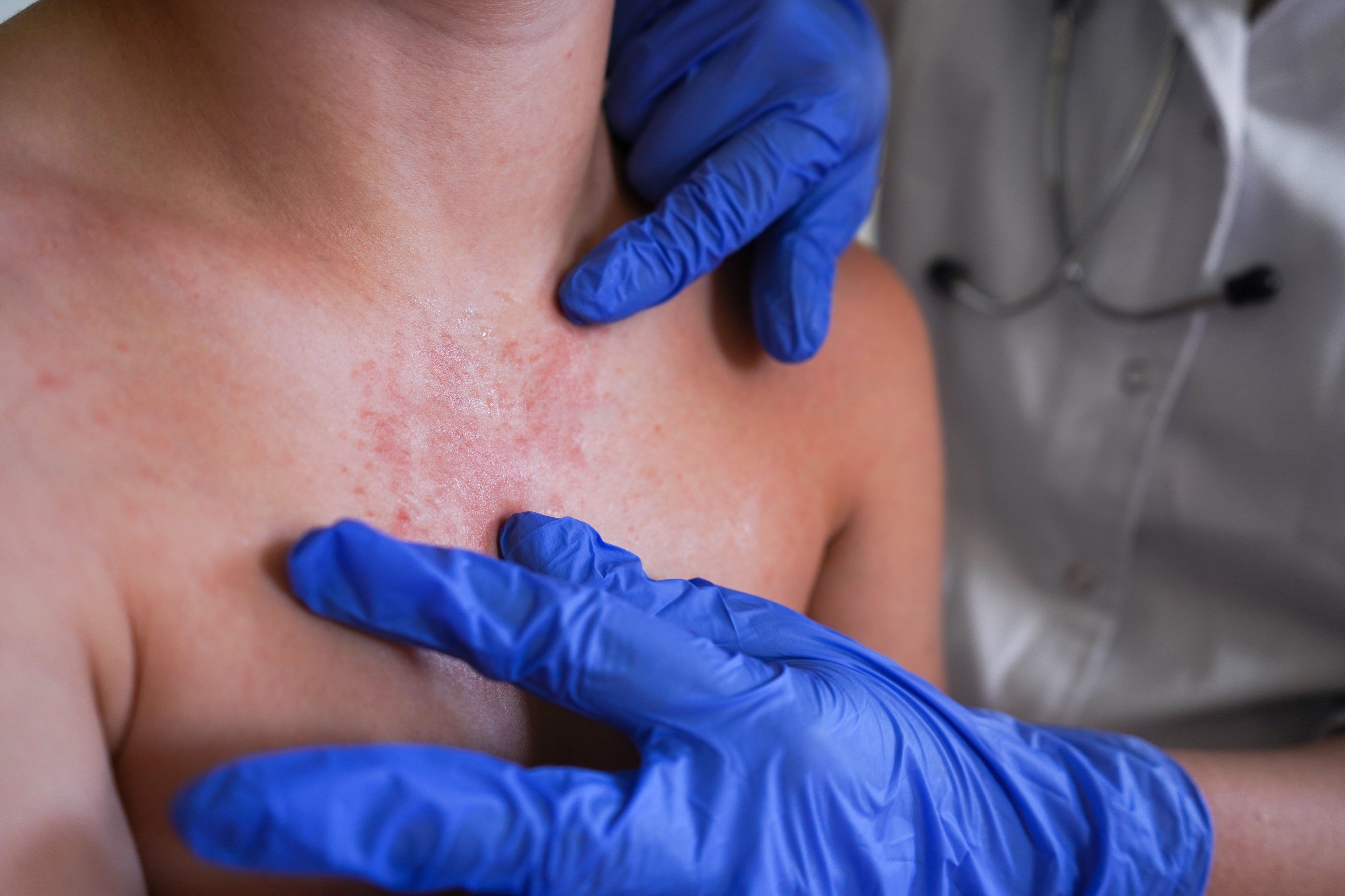 Equipes de saúde monitoram o aumento de sarampo na Flórida, em meio ao debate sobre vacinas.. Reprodução: Elpais