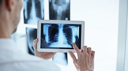 Exames de imagem são fundamentais para a detecção precoce do câncer de pulmão. Reprodução: Globo