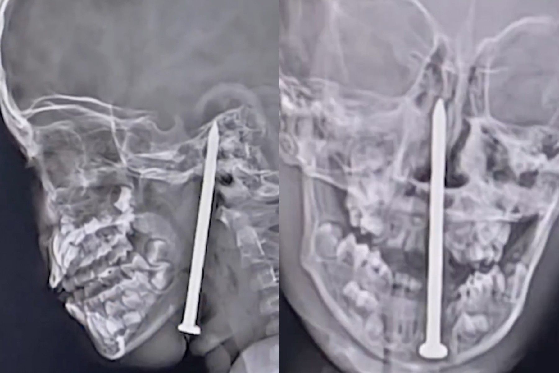 Menino de 7 anos sobrevive a acidente com prego no pescoço, passando por cirurgia complexa.; Reprodução: Globo