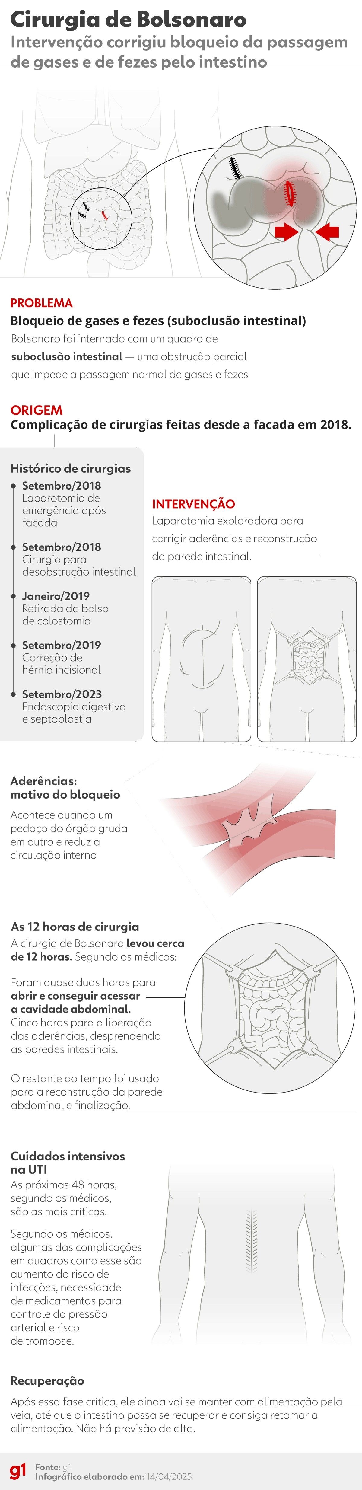 Bolsonaro enfrenta nova obstrução intestinal após cirurgias anteriores. Reprodução: Globo
