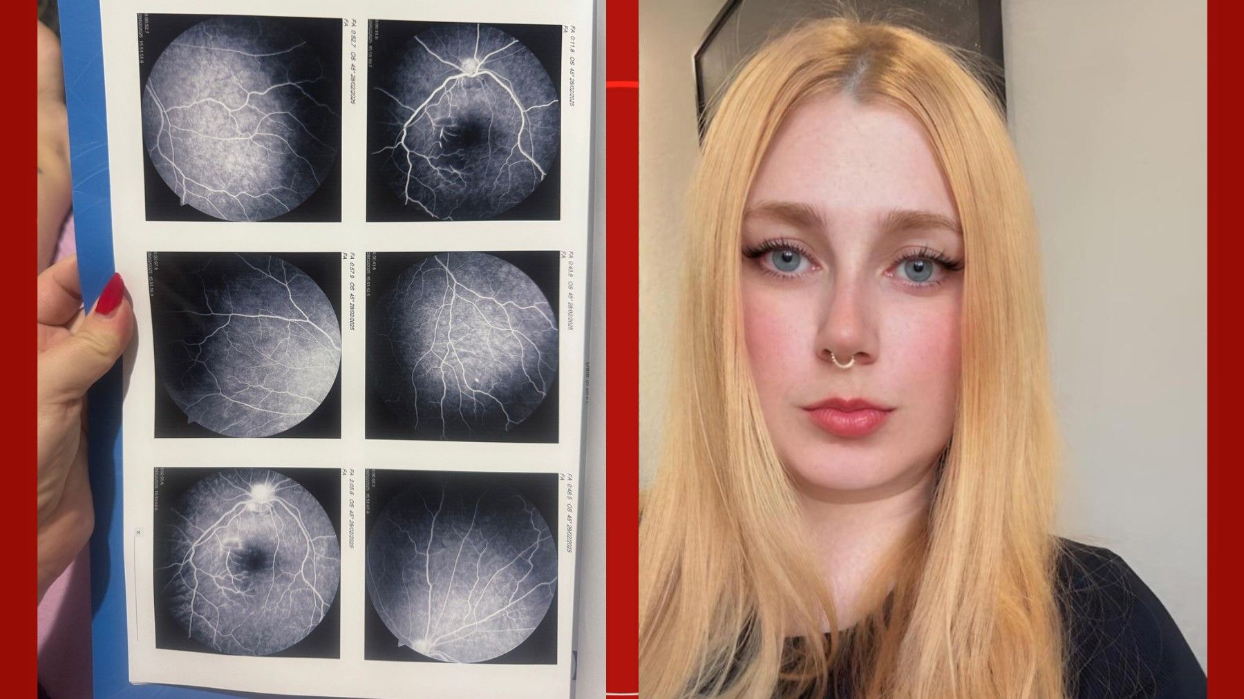 Tais Muchinsky, de 30 anos, descobre rara neurite óptica após mancha na visão. Reprodução: G1