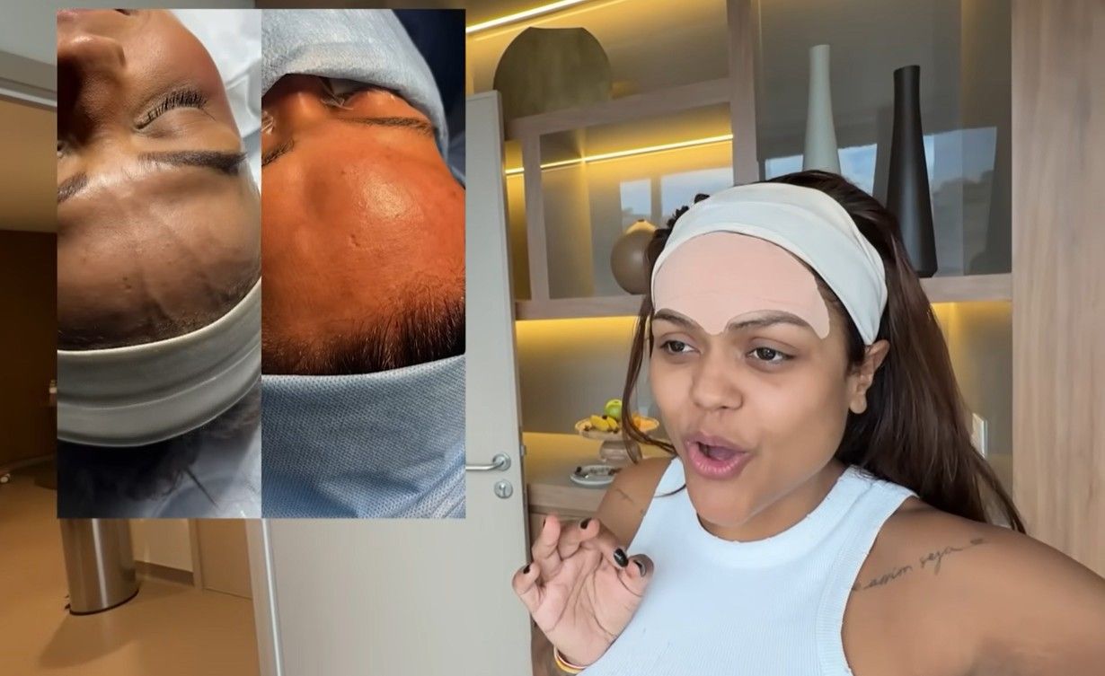 Camila Loures aparece após retirar veia saltada na testa, procedimento sem respaldo científico.. Reprodução: G1