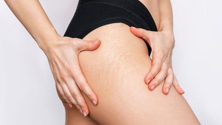 Crema antiestrias promete melhorar a aparência da pele e reduzir marcas. Reprodução: El País