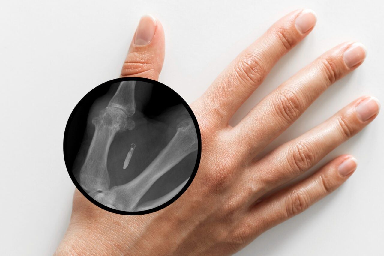 Mão com microchip subcutâneo, tema de banimento para funcionários no Estado de Washington.. Reprodução: Gizmodo