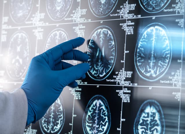 Exame de sangue aponta Alzheimer com mais de 90% de precisão, estudo brasileiro. Reprodução: Retorno do item 11