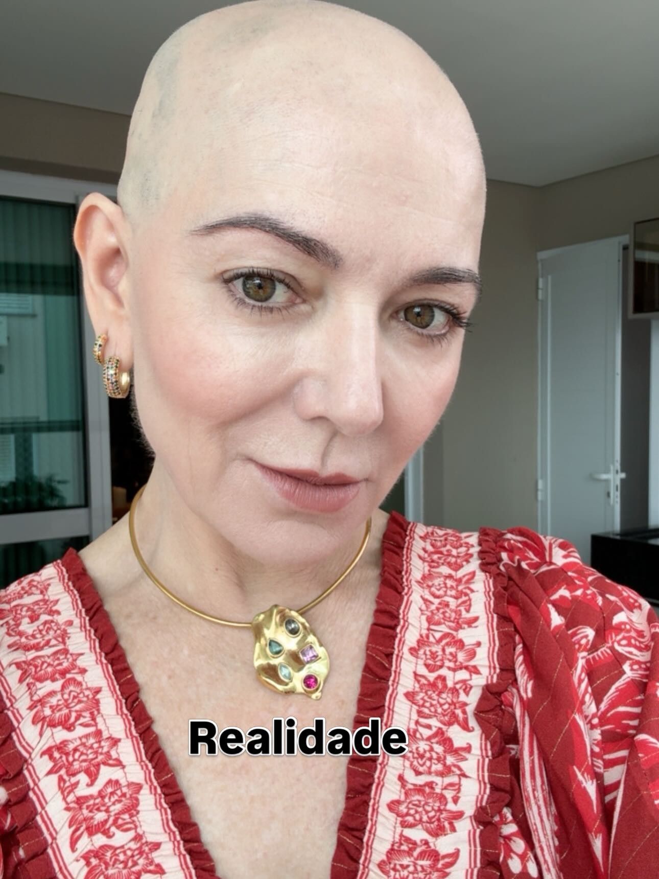 [Karina Lucco, mãe de Lucas Lucco, revela cabeça raspada para tratamento]. Reprodução: Gshow