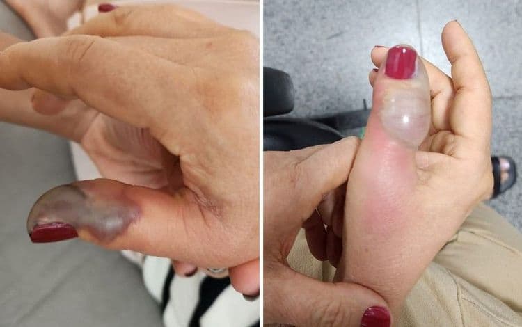 Marise Teixeira, de 66 anos, enfrenta complicações após infecção em dedo provocado por procedimento estético.; Legenda da imagem. Reprodução: g1