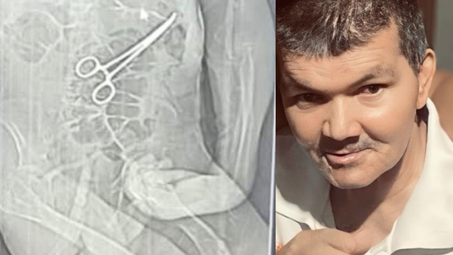 Prefeitura exonera médico e instrumentador após pinça deixada em idoso em MG. Reprodução: G1