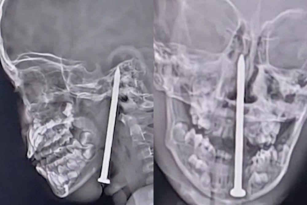 Menino de 7 anos sobrevive a acidente com prego no pescoço, passando por cirurgia complexa.; Reprodução: Globo