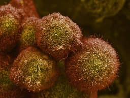Células de câncer de pâncreas observadas em laboratório, refletindo os avanços na pesquisa oncológica. Reprodução: El País