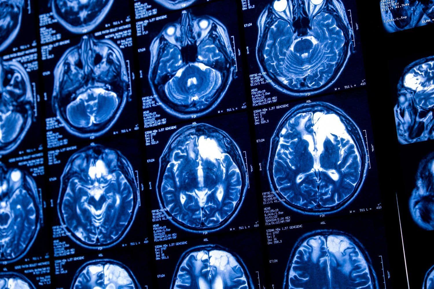Sam Altman prevê fusão entre humanos e tecnologia com o uso de implantes cerebrais.; Reprodução: Gizmodo