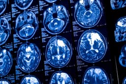 Sam Altman prevê fusão entre humanos e tecnologia com o uso de implantes cerebrais.; Reprodução: Gizmodo