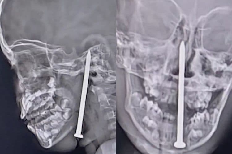 Menino de 7 anos sobrevive a acidente com prego no pescoço, passando por cirurgia complexa.; Reprodução: Globo
