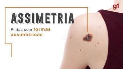 Centro de Oncologia Campinas realiza exames gratuitos para diagnóstico de câncer de pele. Reprodução: Globo