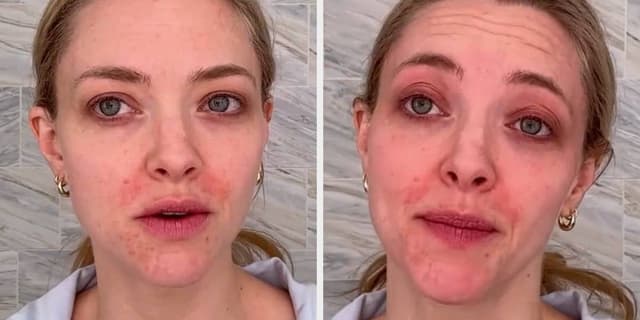 Amanda Seyfried exibe pele natural e revela eczema
