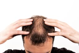 Dra. Carla Nobre discute avanços em tratamentos para alopecia e afinamento capilar em São Luís. Legenda da imagem. Reprodução: Globo